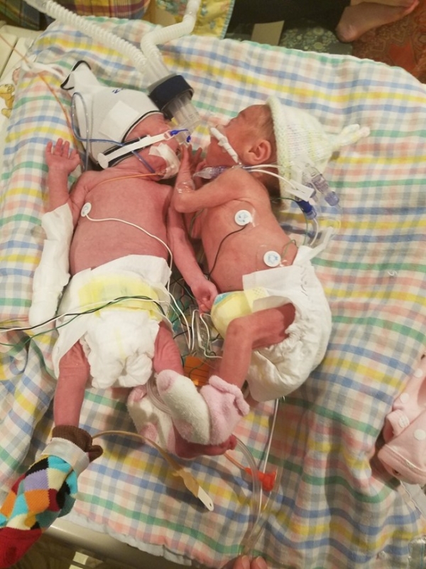 Близнецы родились с разницей в пять недель - «Беременность и роды»