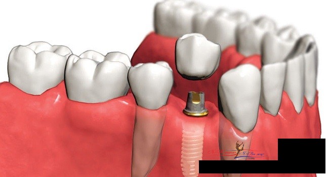 Имплантация зубов – что предлагает рынок?