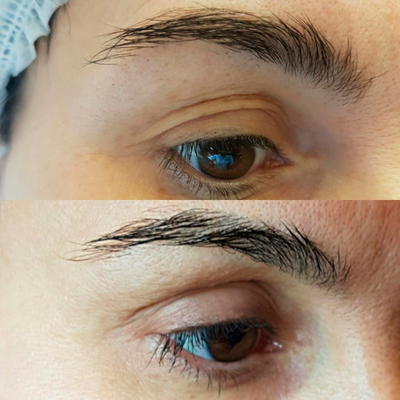 Лазерная шлифовка лица: фото до и после процедур у женщин за 40 - «Красота и здоровье»