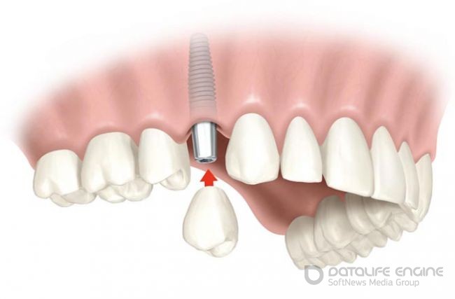 Что такое имплантация зубов - особенности