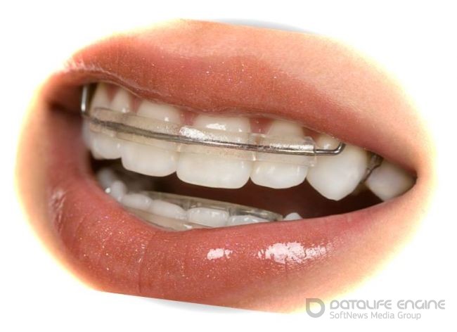 Стоматологические пластины - проблемы неправильного роста им по зубам