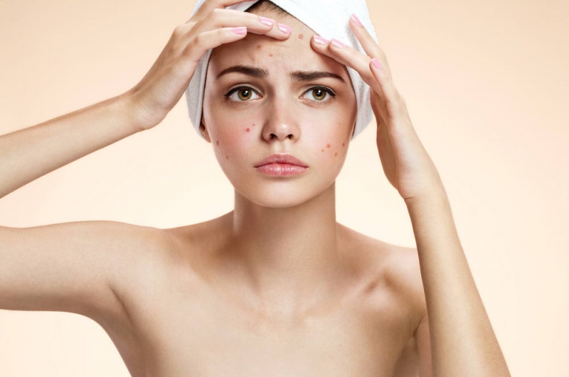 Жирная кожа, усики и акне: решаем косметические проблемы у…гинеколога - «Красота и здоровье»