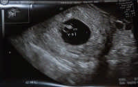 6 неделя беременности - «Календарь беременности»