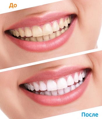 Что важно знать об отбеливании зубов? - «Я и Здоровье»